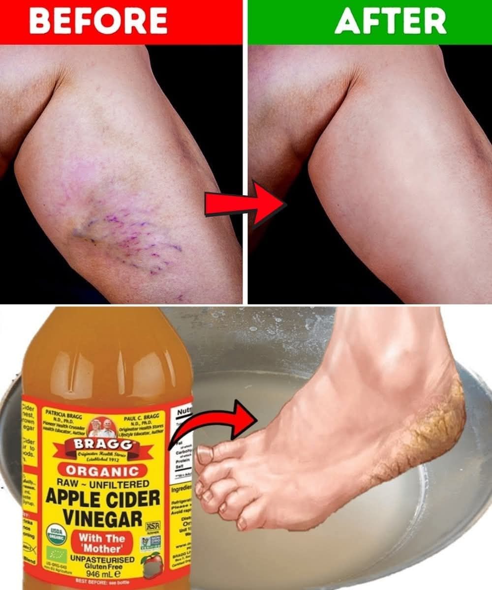 9 Natural Ways to Get Rid of Varicose Veins and Increase Blood Flow