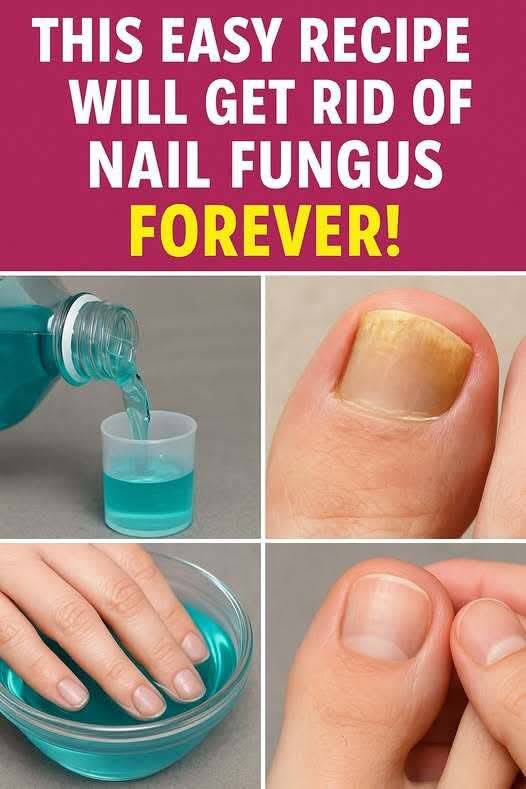 This Easy Recipe Will Get Rid of Nail Fungus – Forever! Using Mouthwash