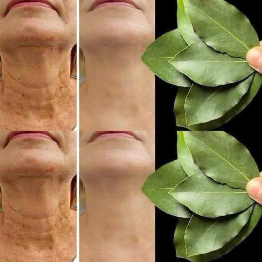 Bay leaf is 100,000 times stronger than Botox. It erases all wrinkles, even at 70.