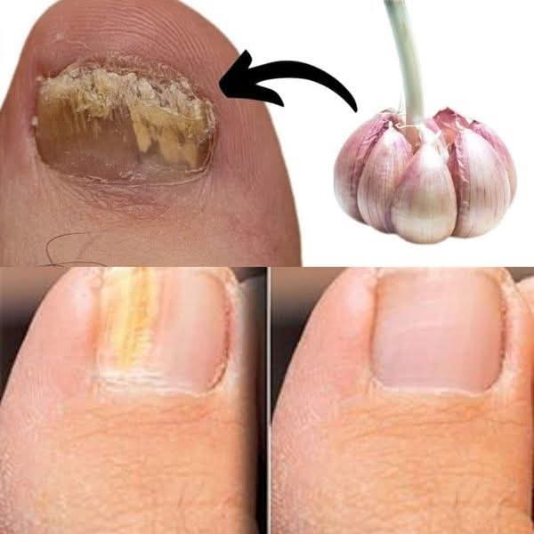 This is a nail fungus killer (It works very fast)