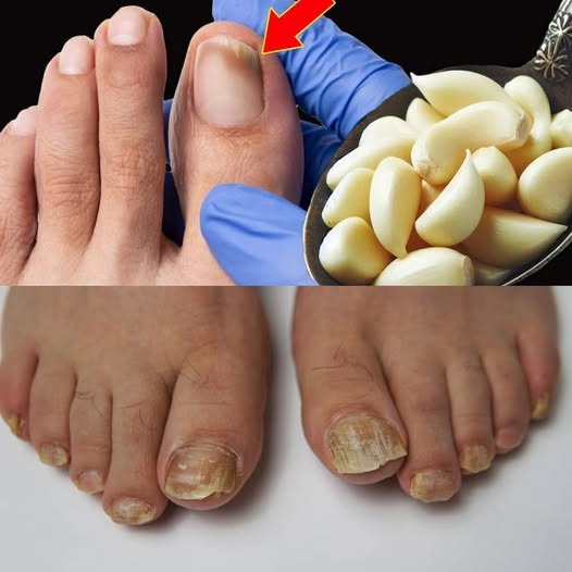 This is a nail fungus killer (It works very fast)