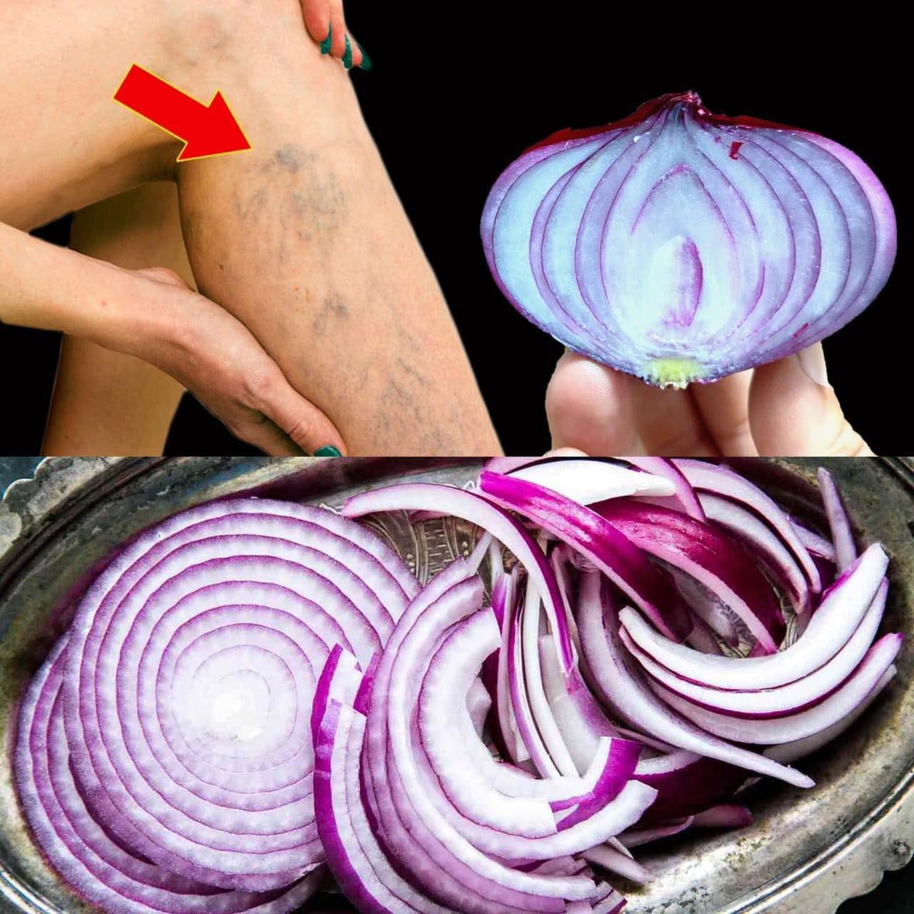 Unbelievable It s a Varicose Vein Killer Red Onion Erases Veins Like an Eraser