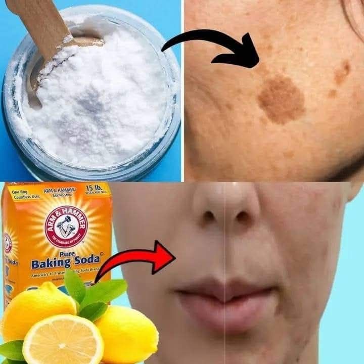Baking soda can help get rid of age spots, acne, and blackheads