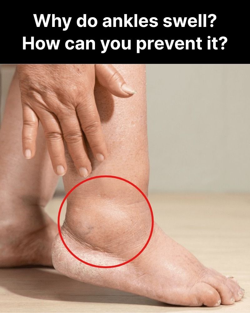 Why do ankles swell? How can you prevent it?